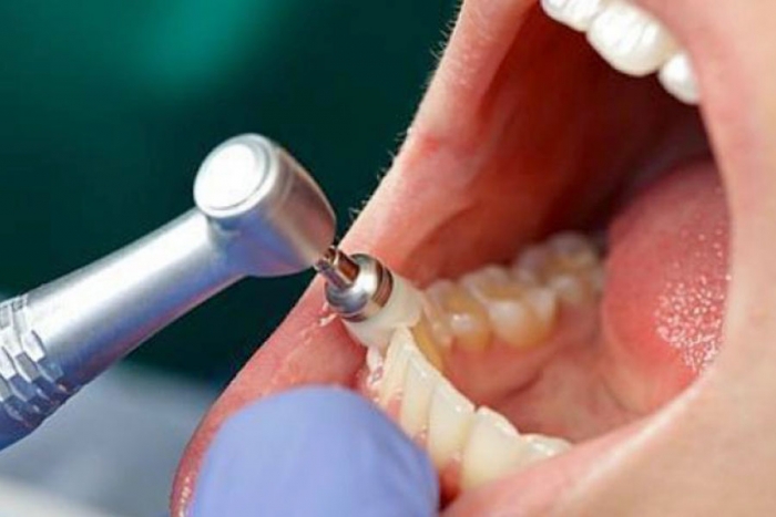 Más del 92% de los mexicanos con caries