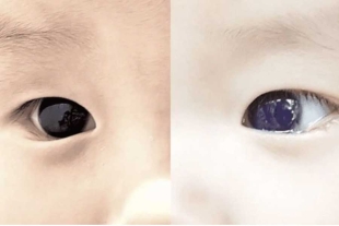 Bebé cambia color de ojos tras tratamiento contra el Covid