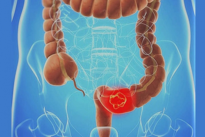 Personas mayores de 50 años tienen mayor riesgo de desarrollar cáncer colorrectal