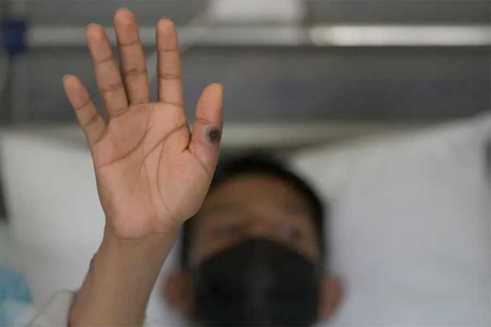 México suma 252 contagios de viruela de mono: SSA
