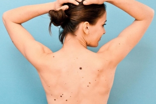 Los lunares podrían ser precursores del Cancer