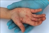 La epidemia silenciosa; avanza brote de sarampión en el país