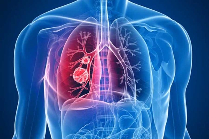 Identifican marcadores de proteínas que ayudan a predecir el cáncer de pulmón