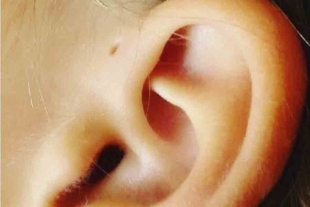 ¿Por qué algunas personas tienen un pequeño agujero en el oído?