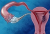 Estudio asocia contaminantes ambientales con un mayor riesgo de padecer cáncer de endometrio