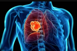 Advierten especialistas que el mejor tratamiento contra el cáncer de pulmón es dejar el cigarro