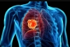 Advierten especialistas que el mejor tratamiento contra el cáncer de pulmón es dejar el cigarro