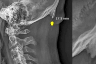 Celulares provocarían crecimiento de cuerno en la cabeza