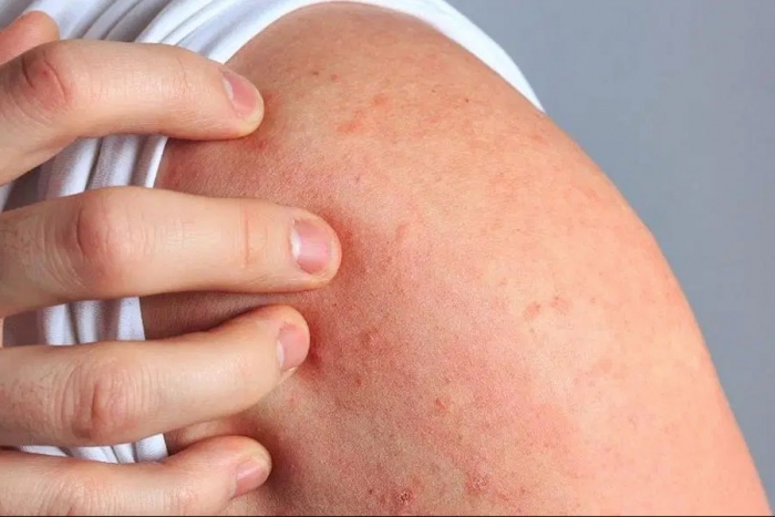 Eczema, ¿qué factores predisponen a los pacientes a padecer esta enfermedad ?