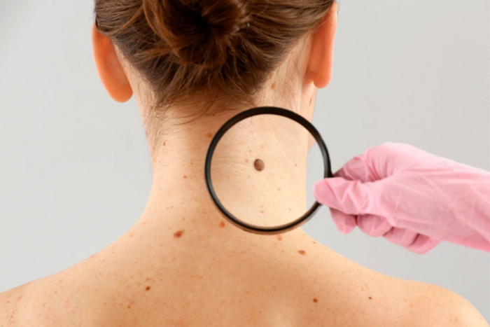 Conoce los signos y síntomas del melanoma